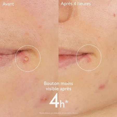 CAUDALIE VINOPURE STOP BOUTONS SALICYLIQUE 15ML